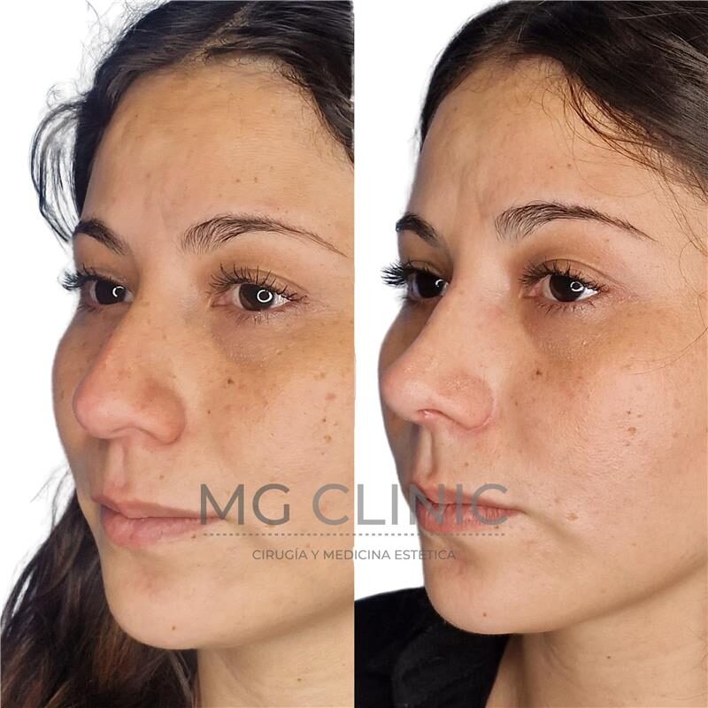 MG Clinic - Ultrasonic Rhinoplasty MG Clinic fotos antes - después